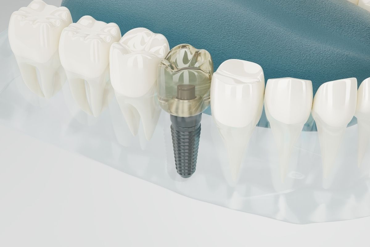 implant-1