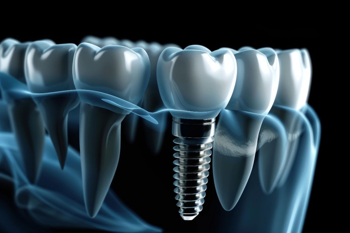 implant-2