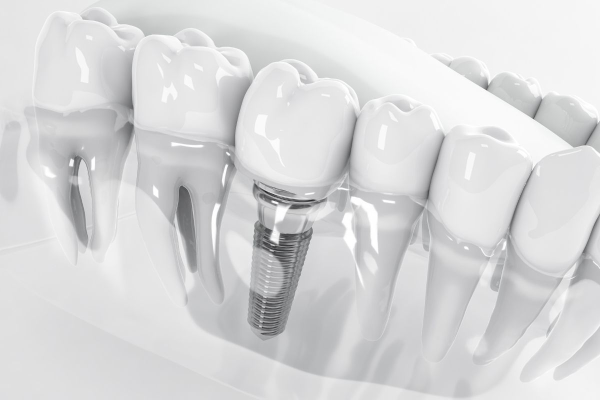 implant-7