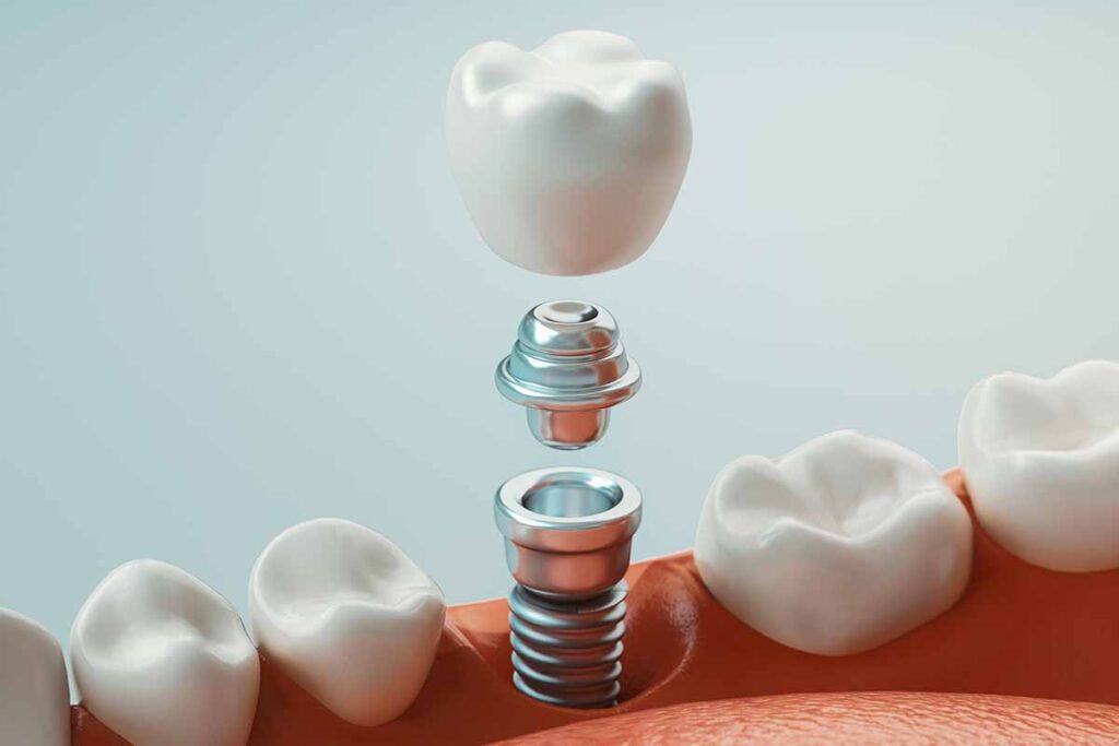 dental-implant-in-turkey