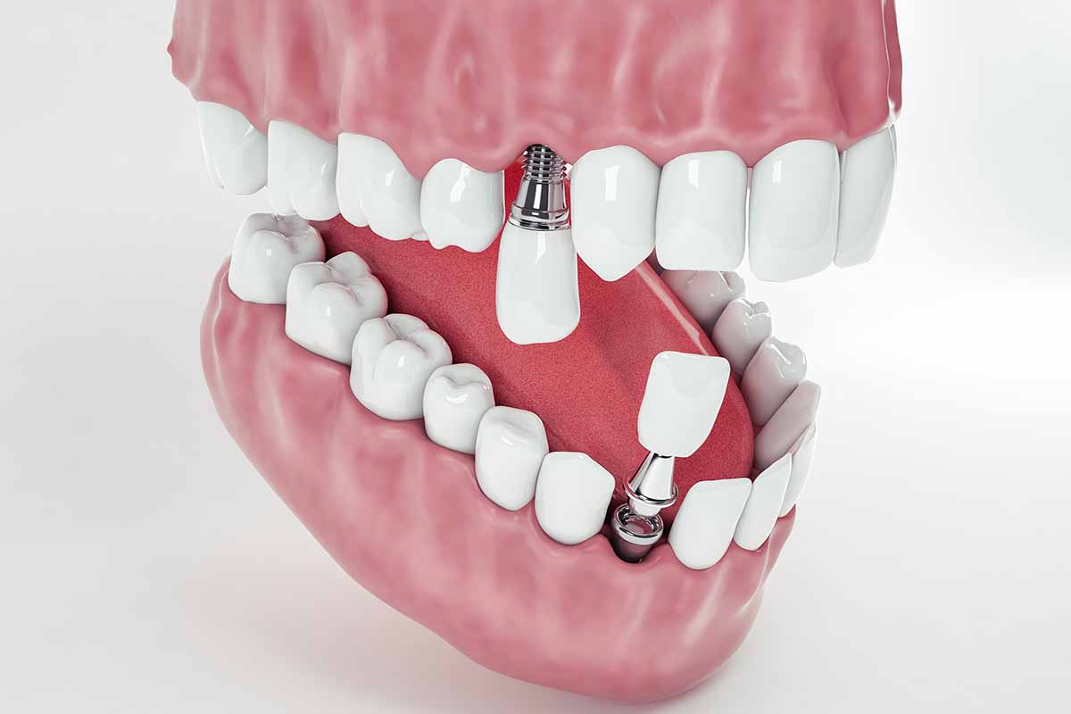 aninda-yukleme-implant-2