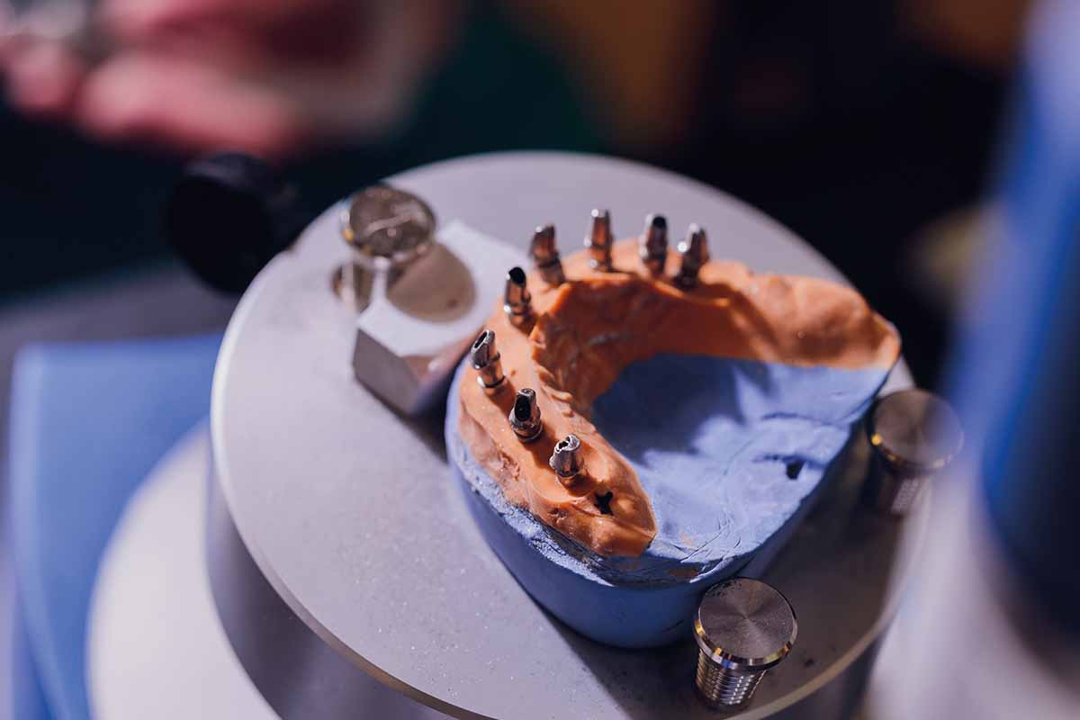 implant-ustu-protezler-4