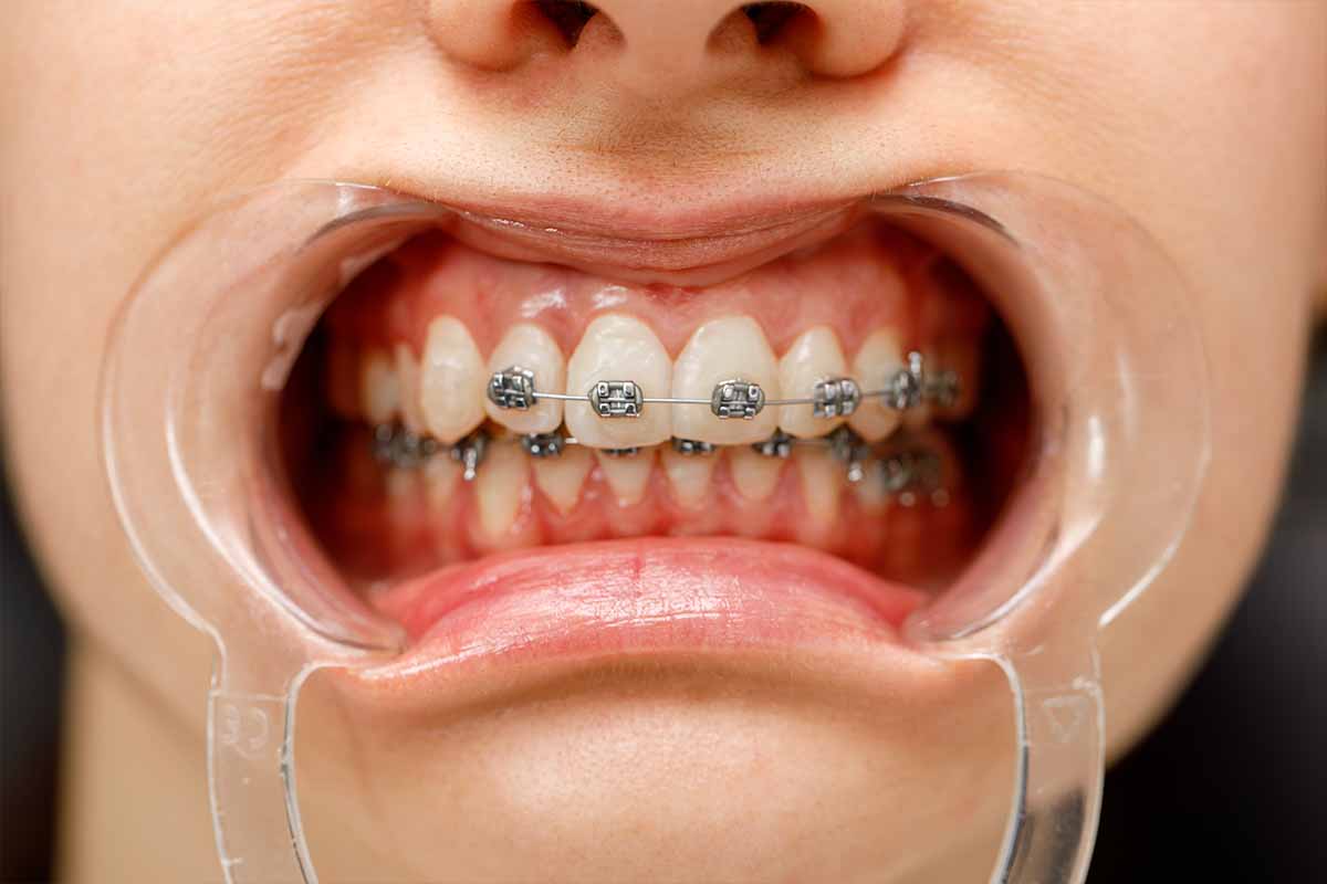 metal-braket-5