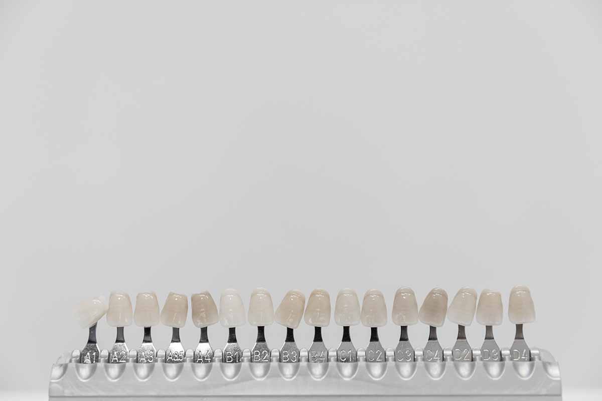 e-max-laminate-veneer-in-turkey