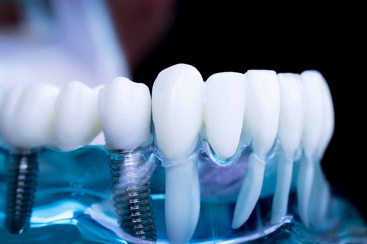 ımpacted-tooth-surgery-in-turkey