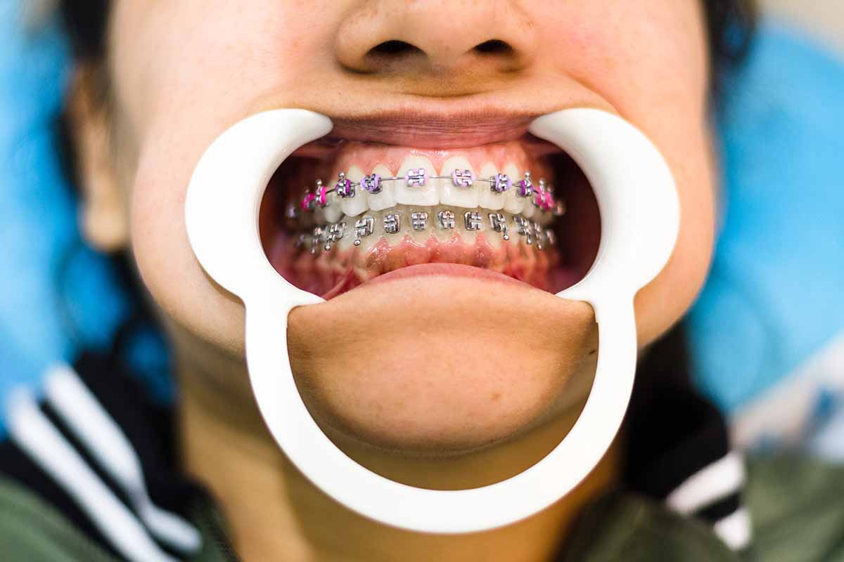 lingual-braces-in-turkey