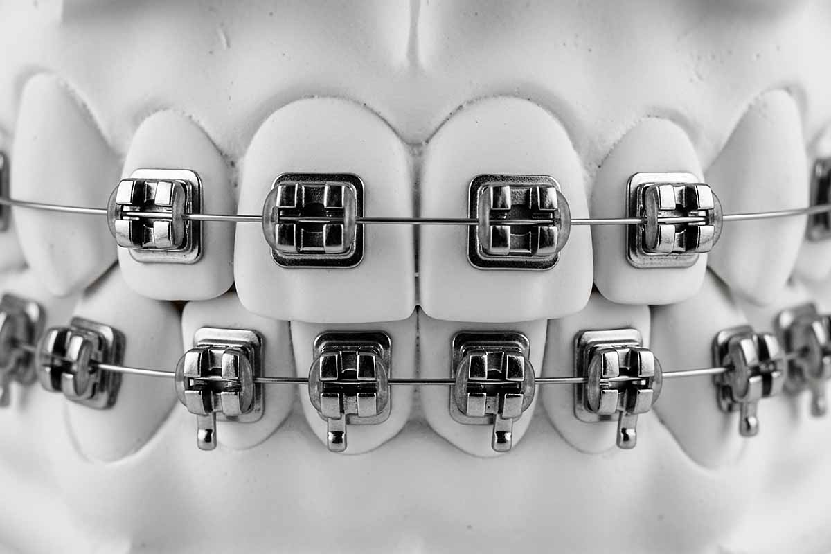 braces-treatment-in-turkey