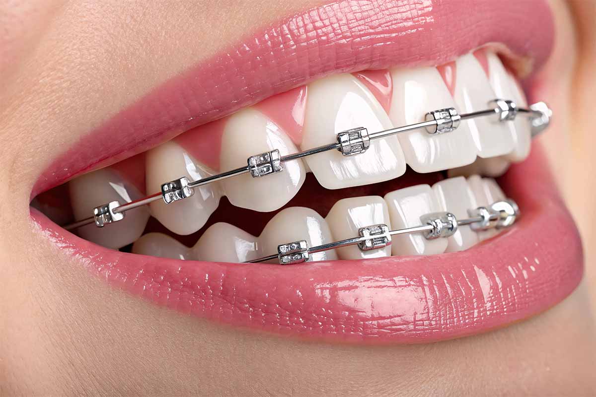 braces-treatment-in-turkey