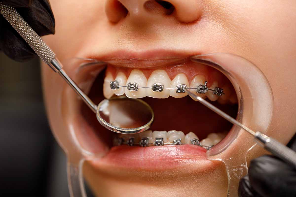 braces-treatment-in-turkey