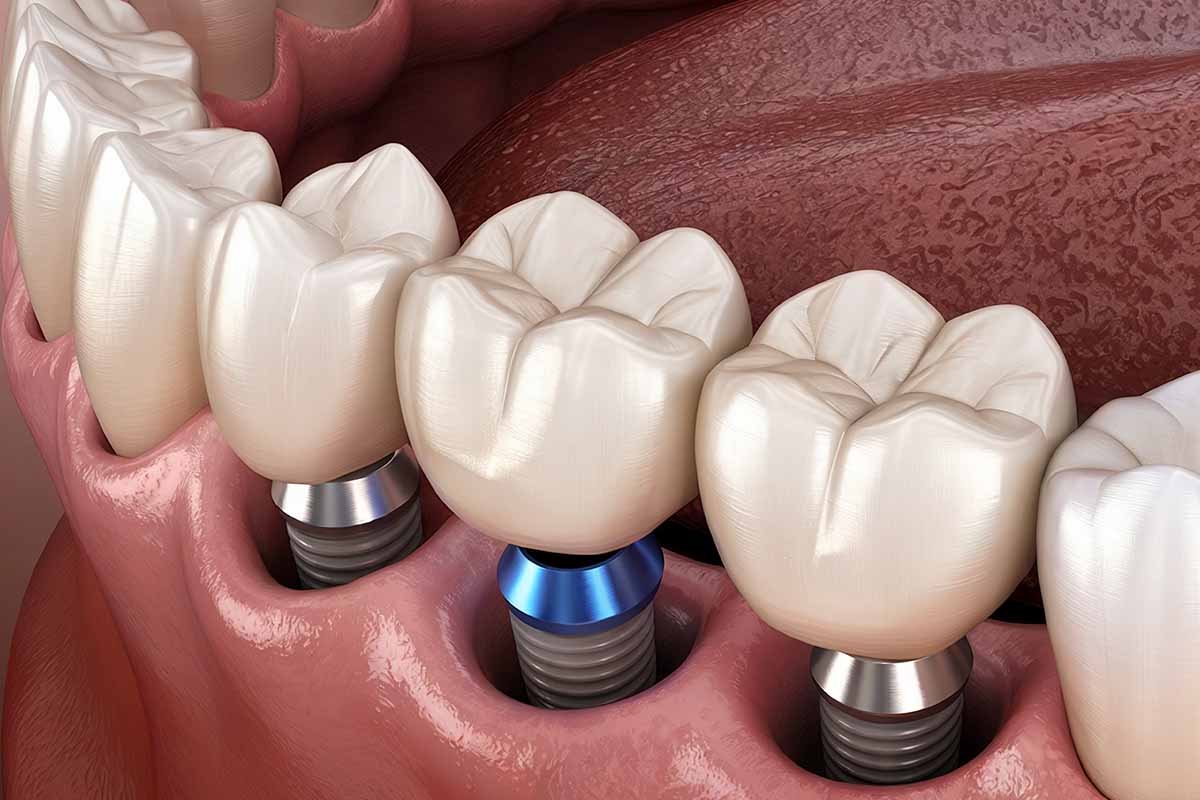 implant-in-turkey