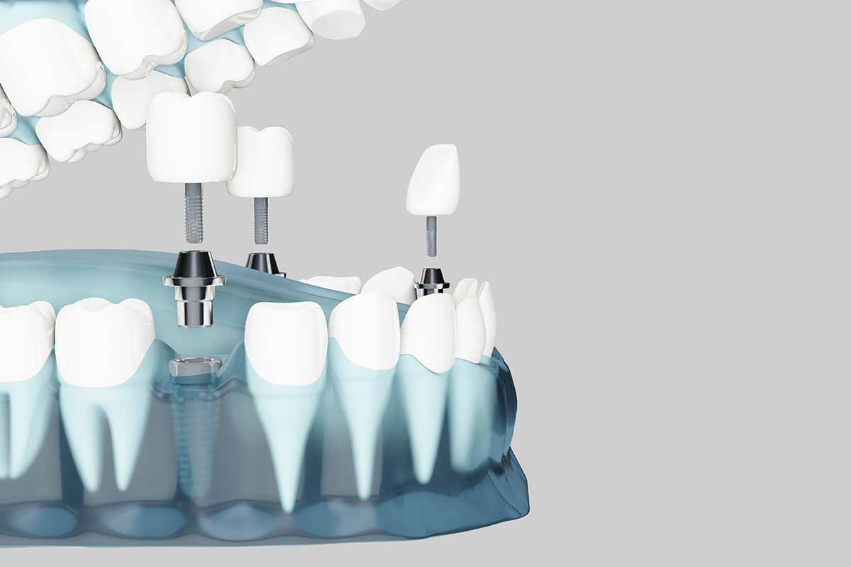 dental-implant-in-turkey
