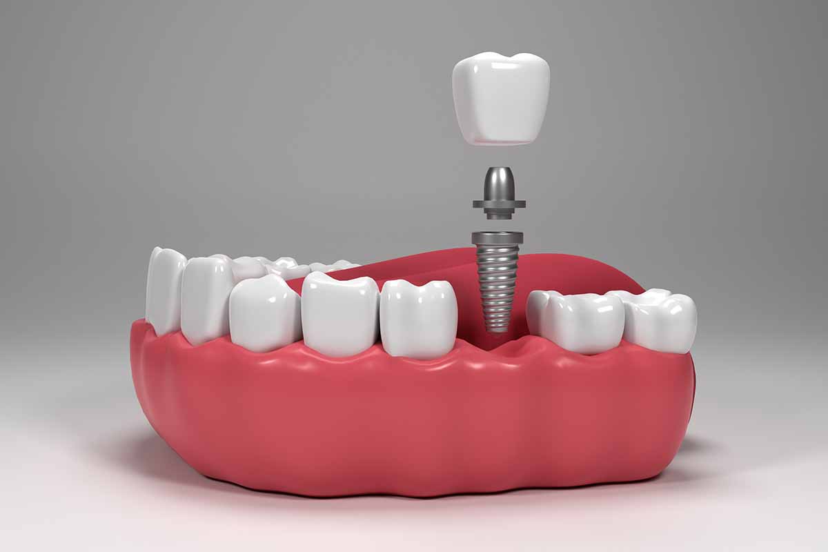 zirconium-implant-in-turkey