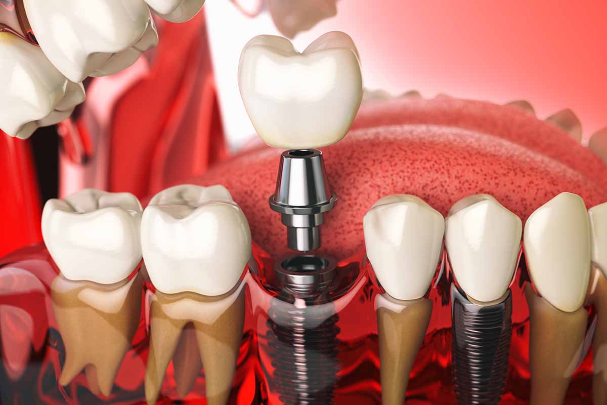 zirconium-implant-in-turkey