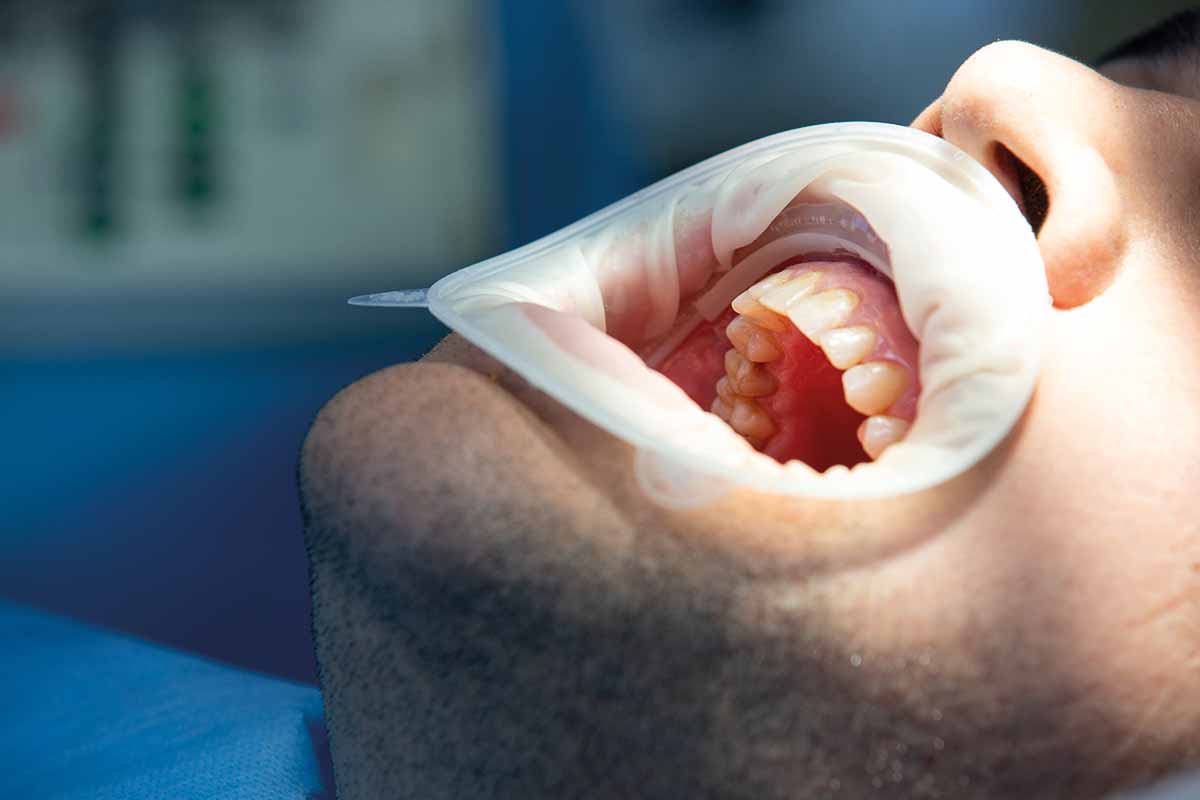 Periodontal Surgery in Turkey