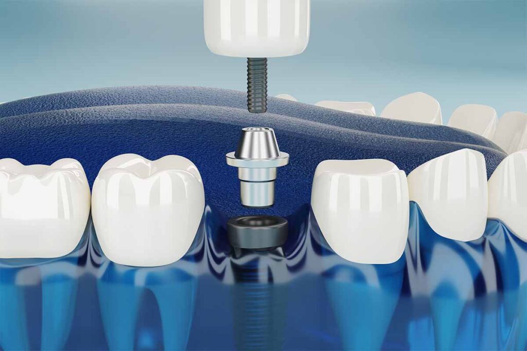 Immediate Load Dental Implants in Turkey
