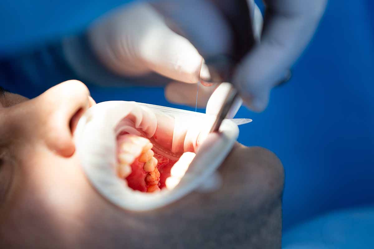 kanal-tedavisi-tekrari-3