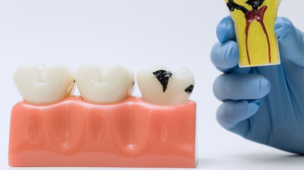 Diş Çürüğü Nasıl Anlaşılır? İlk Belirtiler Nelerdir?