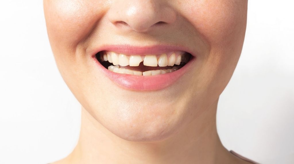 Diş Kırılması Durumunda Ne Yapılmalı? İlk Müdahale Nasıl Olmalı?